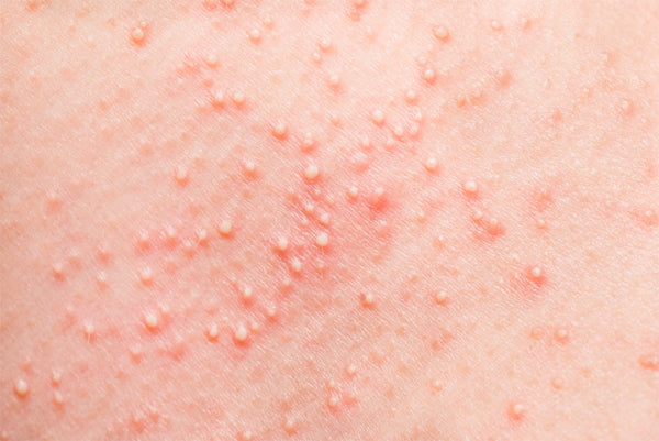 Aromaterapia para psoríase e outros problemas de pele